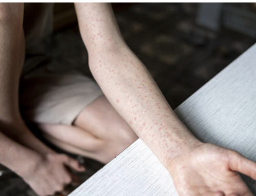 More Measles Outbreaks Put US Total Within Single Digits of Modern-Day Record